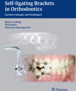 Self-Ligating Brackets in Orthodontics: Current Concepts and Techniques